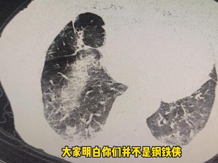 激素是怎么用来治病的 dfe45092db650013f1d9cfece70487ad~tplv-dy-resize-origshort-autoq-75:330.jpeg?biz_tag=pcweb_cover&from=3213915784&s=PackSourceEnum_AWEME_DETAIL&sc=cover&se=false&x-expires=2006197200&x-signature=PdAyGfrqWshjoenVXa6CKtvgitg%3D