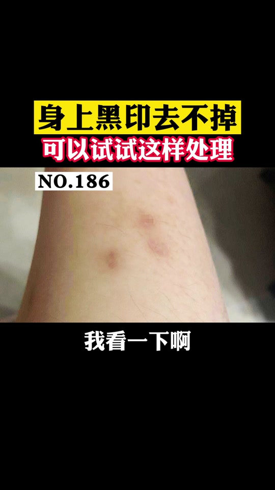 股癣留下的黑色素怎么去除_股癣怎么样才算治好了_股癣留下的黑色素