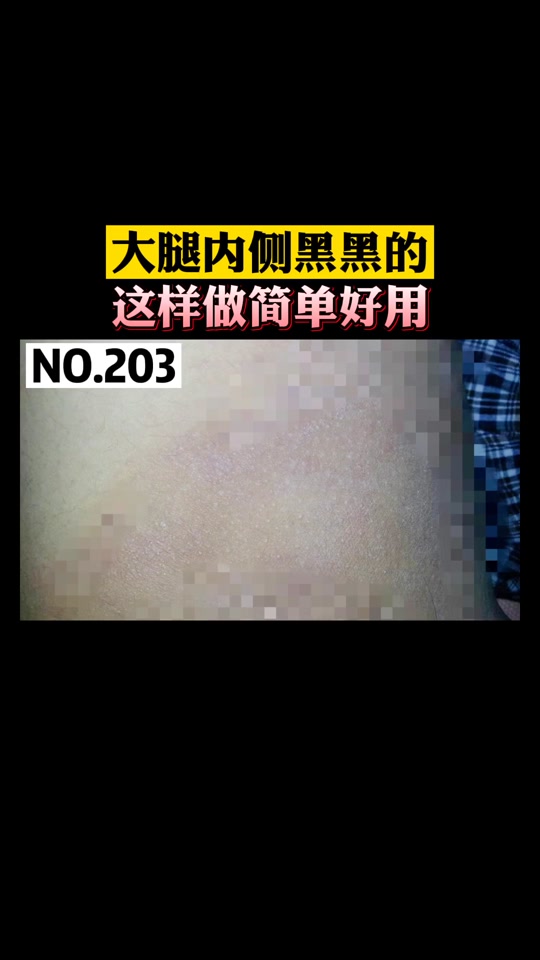 股癣留下的黑色素怎么去除_股癣怎么样才算治好了_股癣留下的黑色素