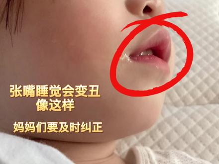 发现张嘴睡觉要及时预防不然长大后龅牙嘴凸下巴短后悔莫及