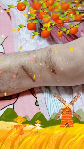 半年了腿还瘸呢阴天下雨疼啊